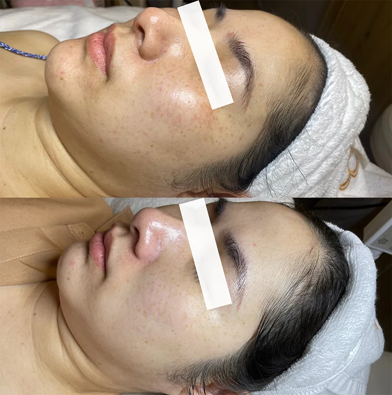 Khách Hàng Nữ Tiêm Mesotherapy