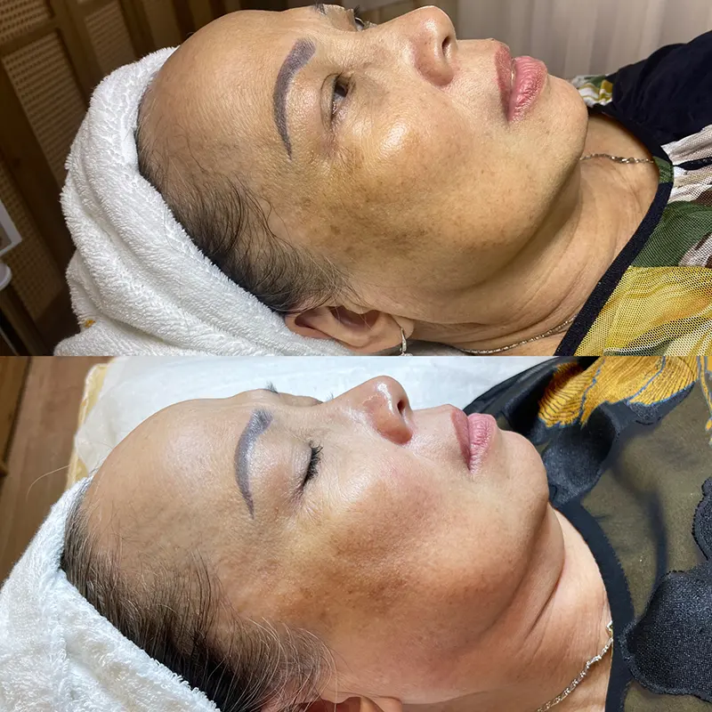 Khách Hàng Nữ Tiêm Mesotherapy